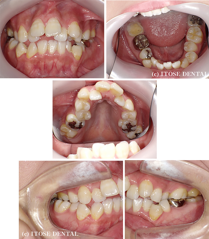 インビザラインの症例1