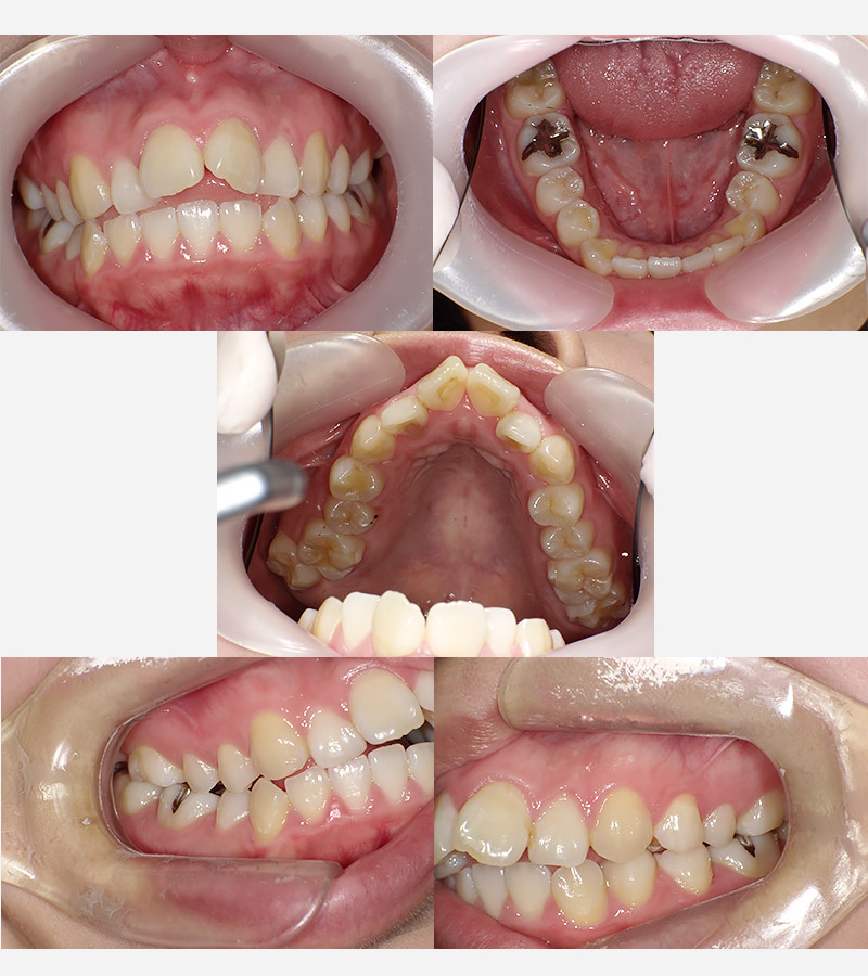インビザラインの症例01