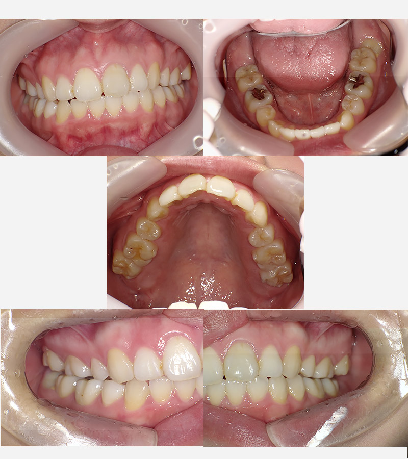 インビザラインの症例2