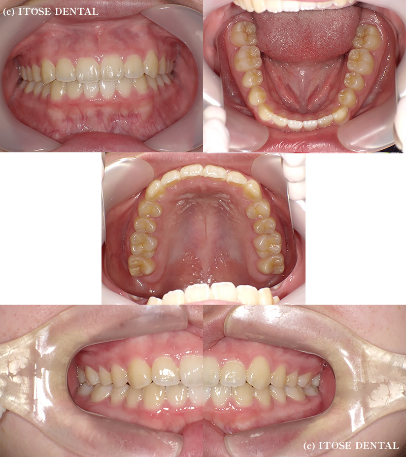 インビザライン開咬症例2