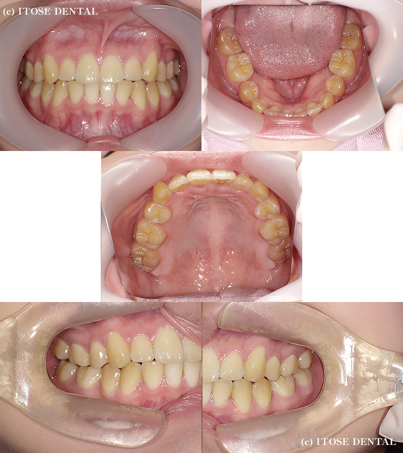 インビザライン症例3の矯正治療後