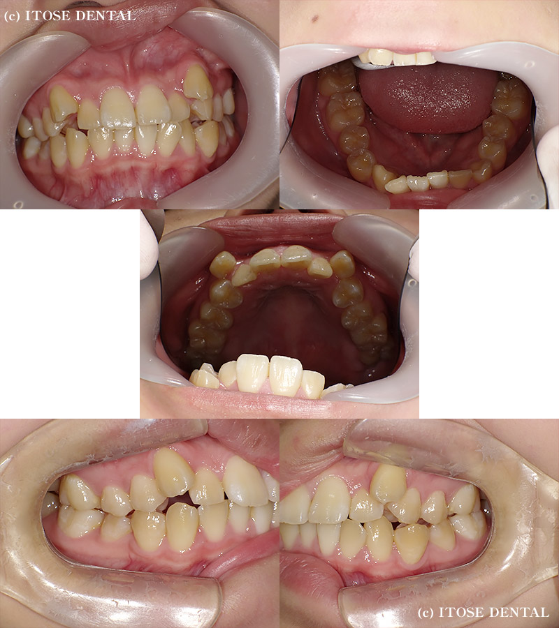 インビザライン症例3の矯正治療後
