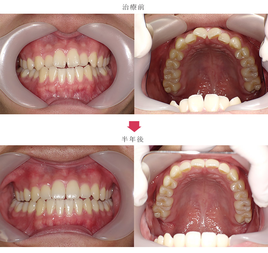 反対咬合、非抜歯の症例
