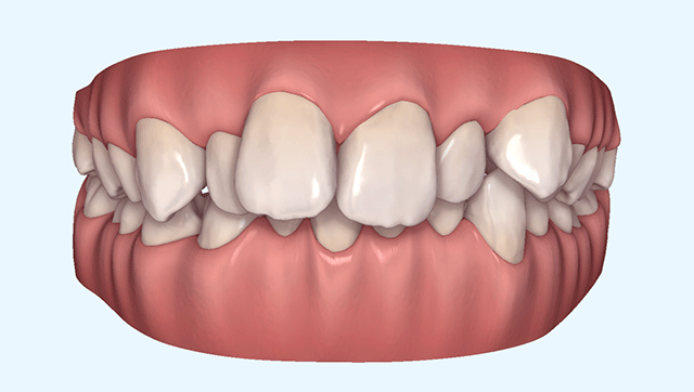 出っ歯の症例