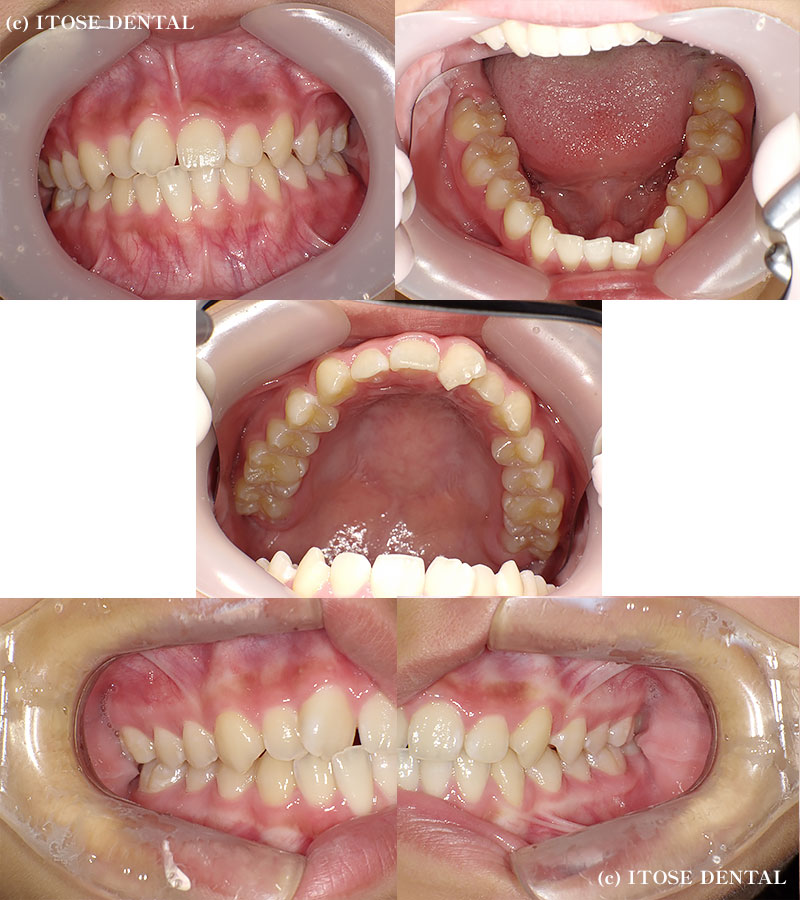 インビザライン治療前