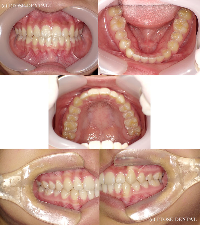 インビザライン治療中