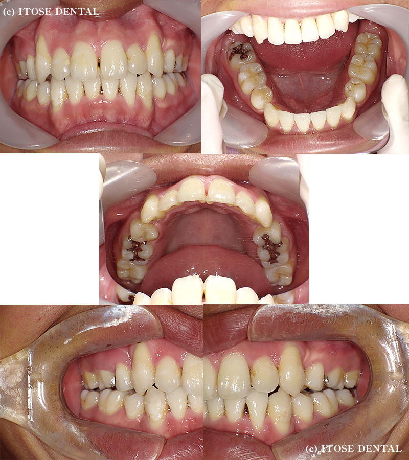 インビザラインの治療症例