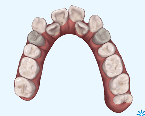 上下抜歯でインビザラインで治療した症例 重度の叢生 大分の矯正歯科なら新港イトセ歯科