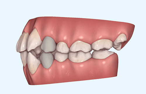 上下抜歯でインビザラインで治療した症例 重度の叢生 大分の矯正歯科なら新港イトセ歯科