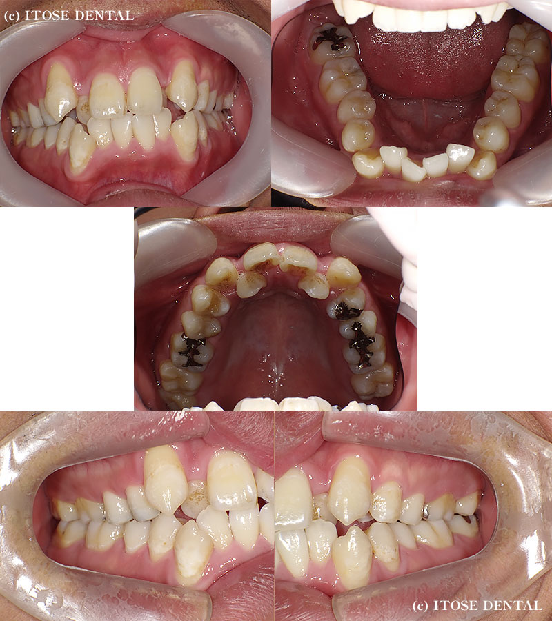 上下抜歯でインビザラインで治療した症例 重度の叢生 大分の矯正歯科なら新港イトセ歯科