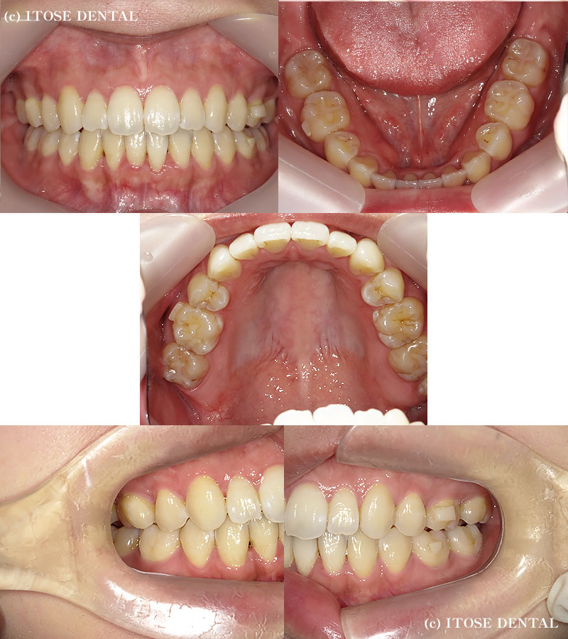 開咬の症例、治療後