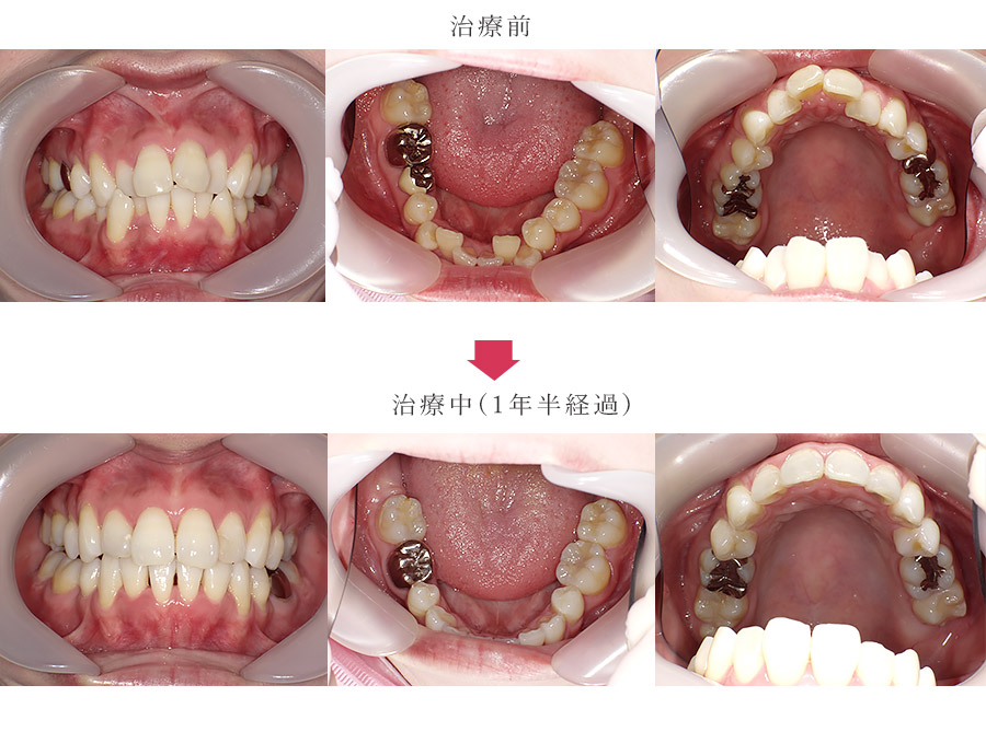 上下顎前突と叢生を短期間で改善している症例
