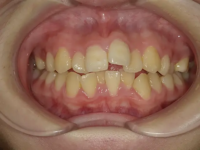 症例1 治療前